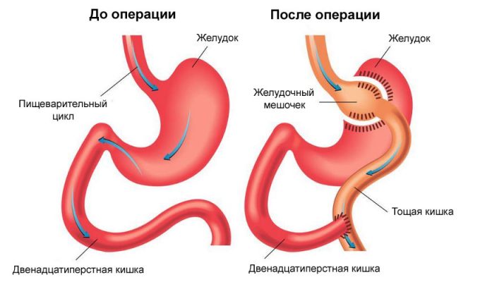 Шунтирование желудка для хирургия ожирения