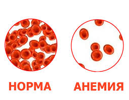 человек с низким кровяным давлением, анемией и нормальной кровью